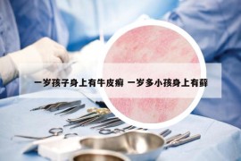 一歲孩子身上有牛皮癬 一歲多小孩身上有蘚