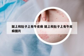腿上和肚子上有牛皮癬 腿上和肚子上有牛皮癬圖片