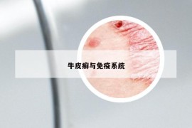 牛皮癬與免疫系統(tǒng)