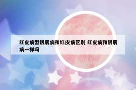 紅皮病型銀屑病和紅皮病區(qū)別 紅皮病和銀屑病一樣嗎
