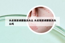 頭皮銀屑病要勤洗頭么 頭皮銀屑病要勤洗頭么嗎