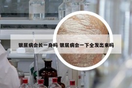 銀屑病會長一身嗎 銀屑病會一下全發(fā)出來嗎