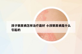 孩子銀屑病怎樣治療最好 小孩銀屑病是什么引起的