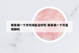 銀屑病一個月時間能治好嗎 銀屑病一個月是初期嗎