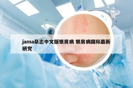 jama雜志中文版銀屑病 銀屑病國(guó)際最新研究