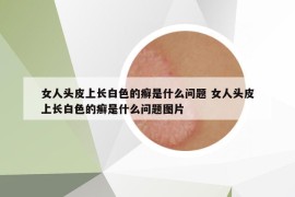 女人頭皮上長白色的癬是什么問題 女人頭皮上長白色的癬是什么問題圖片