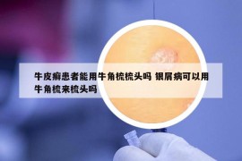 牛皮癬患者能用牛角梳梳頭嗎 銀屑病可以用牛角梳來梳頭嗎