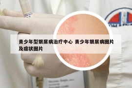 青少年型銀屑病治療中心 青少年銀屑病圖片及癥狀圖片
