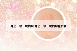 身上一塊一塊的癬 身上一塊一塊的癬在擴(kuò)散