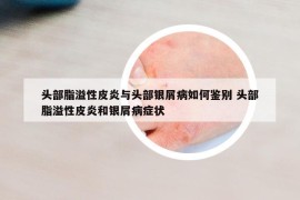 頭部脂溢性皮炎與頭部銀屑病如何鑒別 頭部脂溢性皮炎和銀屑病癥狀