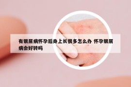 有銀屑病懷孕后身上長很多怎么辦 懷孕銀屑病會好轉嗎
