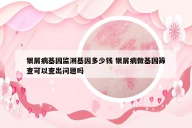 銀屑病基因監(jiān)測(cè)基因多少錢 銀屑病做基因篩查可以查出問題嗎