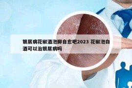 銀屑病花椒酒泡腳自愈吧2023 花椒泡白酒可以治銀屑病嗎