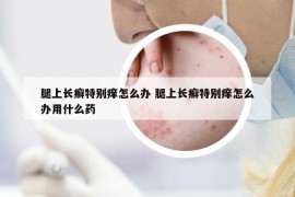 腿上長癬特別癢怎么辦 腿上長癬特別癢怎么辦用什么藥