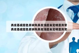 表皮基底層色素缺失真皮淺層未見明顯異常 表皮基底層色素缺失真皮淺層未見明顯異常