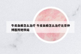 牛皮血癬怎么治療 牛皮血癬怎么治療北京仲博醫(yī)院地鐵站