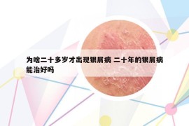 為啥二十多歲才出現(xiàn)銀屑病 二十年的銀屑病能治好嗎