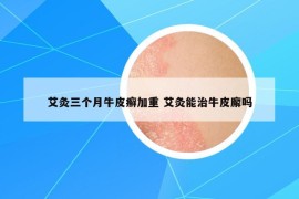艾灸三個(gè)月牛皮癬加重 艾灸能治牛皮廨嗎