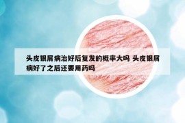 頭皮銀屑病治好后復發(fā)的概率大嗎 頭皮銀屑病好了之后還要用藥嗎