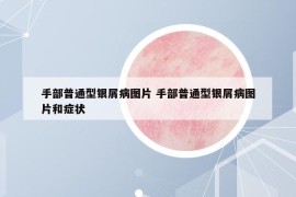 手部普通型銀屑病圖片 手部普通型銀屑病圖片和癥狀