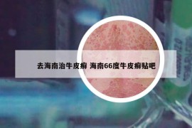 去海南治牛皮癬 海南66度牛皮癬貼吧
