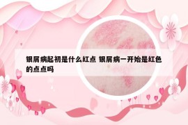 銀屑病起初是什么紅點(diǎn) 銀屑病一開(kāi)始是紅色的點(diǎn)點(diǎn)嗎