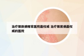 治療銀削病哪家醫(yī)院最權(quán)威 治療銀屑病最權(quán)威的醫(yī)院