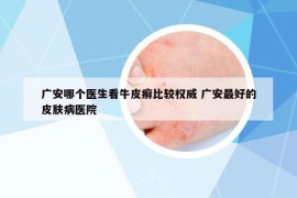 廣安哪個醫(yī)生看牛皮癬比較權(quán)威 廣安最好的皮膚病醫(yī)院