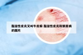 脂溢性皮炎又叫牛皮癬 脂溢性皮炎和銀屑病的圖片
