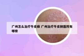 廣州怎么治療牛皮癬 廣州治療牛皮鮮醫(yī)院有哪些