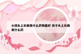 小孩頭上長癬用什么藥物最好 孩子頭上長癬用什么藥