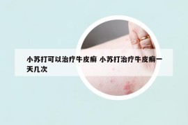 小蘇打可以治療牛皮癬 小蘇打治療牛皮癬一天幾次