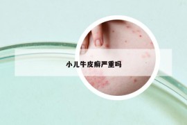 小兒牛皮癬嚴重嗎