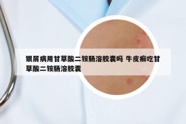 銀屑病用甘草酸二銨腸溶膠囊嗎 牛皮癬吃甘草酸二銨腸溶膠囊