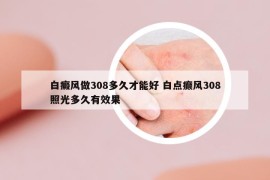 白癜風(fēng)做308多久才能好 白點(diǎn)癲風(fēng)308照光多久有效果