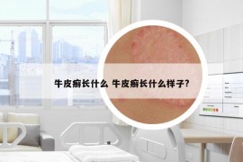 牛皮癬長什么 牛皮癬長什么樣子?