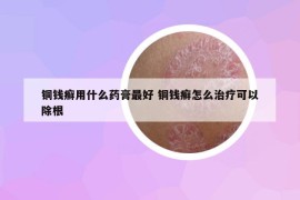 銅錢癬用什么藥膏最好 銅錢癬怎么治療可以除根