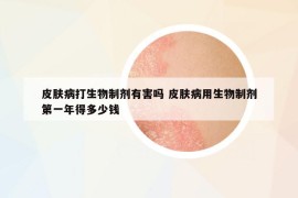 皮膚病打生物制劑有害嗎 皮膚病用生物制劑第一年得多少錢