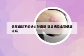 銀屑病能不能通過健康證 銀屑病能拿到健康證嗎