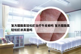 復(fù)方醋酸氟輕松酊治療牛皮癬嗎 復(fù)方醋酸氟輕松酊殺真菌嗎