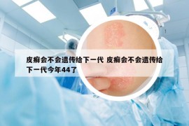 皮癬會不會遺傳給下一代 皮癬會不會遺傳給下一代今年44了