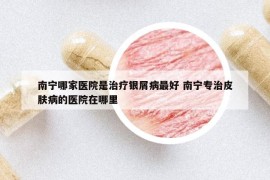 南寧哪家醫(yī)院是治療銀屑病最好 南寧專治皮膚病的醫(yī)院在哪里