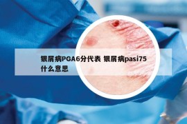 銀屑病PGA6分代表 銀屑病pasi75什么意思