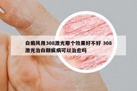 白癜風(fēng)用308激光那個(gè)效果好不好 308激光治白顛瘋病可以治愈嗎