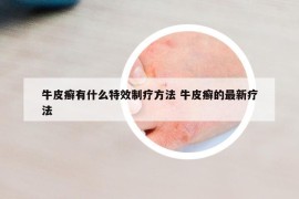 牛皮癬有什么特效制療方法 牛皮癬的最新療法