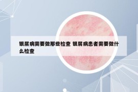 銀屑病需要做那些檢查 銀屑病患者需要做什么檢查