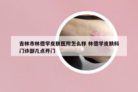 吉林市林德學(xué)皮膚醫(yī)院怎么樣 林德學(xué)皮膚科門診部幾點(diǎn)開(kāi)門