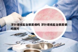 浮針埋線能治銀屑病嗎 浮針埋線能治銀屑病嗎圖片