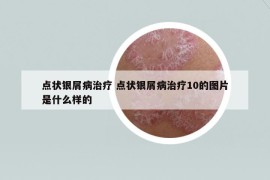 點(diǎn)狀銀屑病治療 點(diǎn)狀銀屑病治療10的圖片是什么樣的