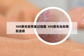 308激光后恢復(fù)過(guò)程圖 308激光治白斑后遺癥